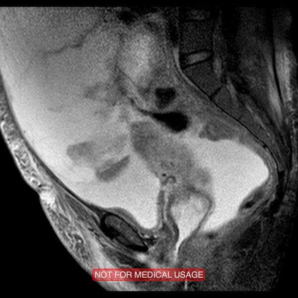File:Adenocarcinoma of the cervix (Radiopaedia 28373-28615 Sagittal T2 fat sat 7).jpg