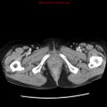 Adenocarcinoma of the colon (Radiopaedia 8191-9039 Axial liver window 80).jpg