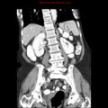 Adenocarcinoma of the colon (Radiopaedia 8191-9039 Coronal liver window 30).jpg