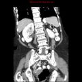 Adenocarcinoma of the colon (Radiopaedia 8191-9039 Coronal liver window 33).jpg