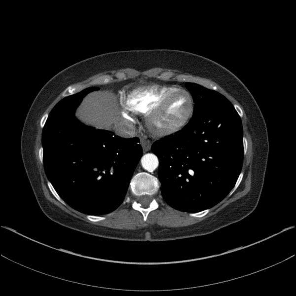 File:Adenocarcinoma of the lung (Radiopaedia 44205-47803 Axial C+ portal venous phase 64).jpg