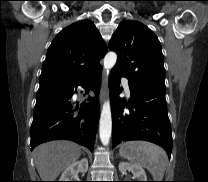 File:Adenocarcinoma of the lung (Radiopaedia 44205-47803 Coronal C+ portal venous phase 59).jpg
