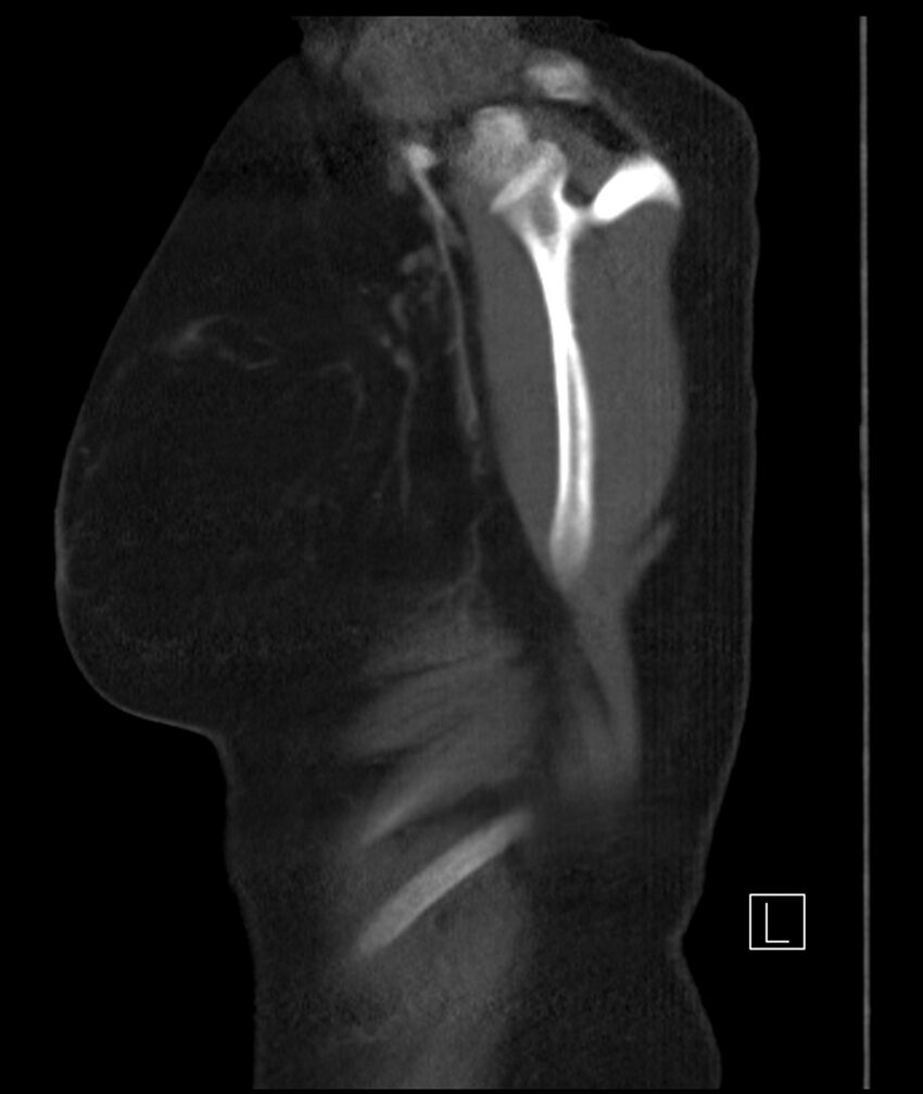 Adenocarcinoma of the lung (Radiopaedia 44205-47803 Sagittal C+ portal venous phase 45).jpg