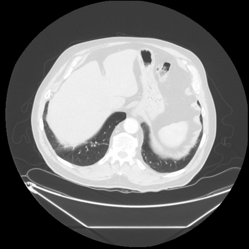Adenocarcinoma of the lung (Radiopaedia 44876-48759 Axial lung window 70).jpg