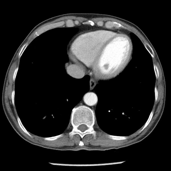 File:Adenocarcinoma of the lung - micropapillary predominant (Radiopaedia 42446-45563 Axial C+ portal venous phase 57).jpg