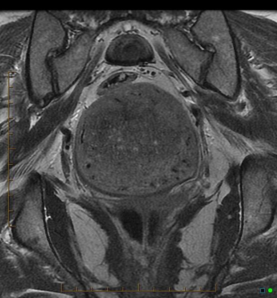 File:Adenomyosis uterus with hematometra (Radiopaedia 45779-50011 Coronal T2 17).jpg