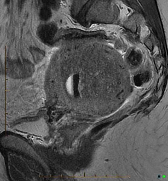 File:Adenomyosis uterus with hematometra (Radiopaedia 45779-50011 Sagittal T2 11).jpg