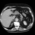 Adrenal hemangioma (Radiopaedia 11039-11445 Axial C+ portal venous phase 4).jpg