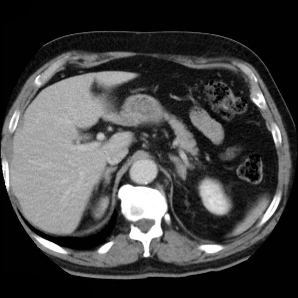 File:Adrenal hemangioma (Radiopaedia 11039-11445 Axial C+ portal venous phase 4).jpg