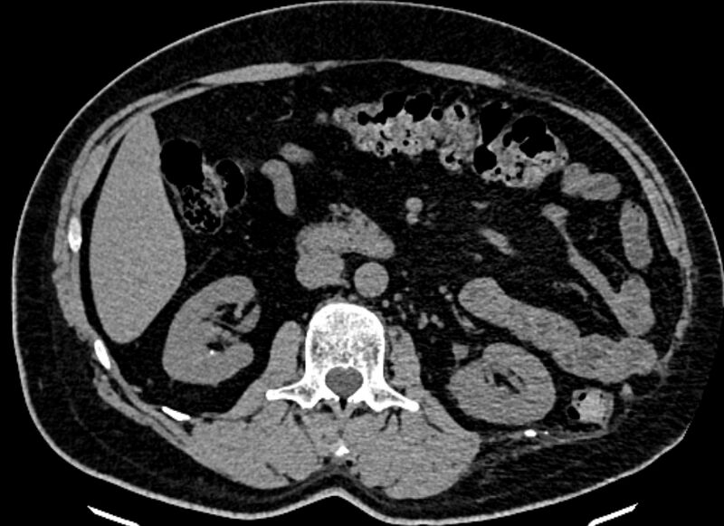 File:Adrenal metastases (Radiopaedia 73082-83791 Axial non-contrast 82).jpg