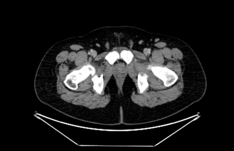 File:Adrenocortical carcinoma (Radiopaedia 80134-93438 Axial C+ portal venous phase 134).jpg