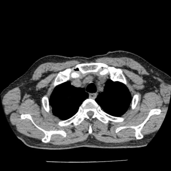 File:Airway foreign body in adult (Radiopaedia 85907-101779 Axial liver window 7).jpg