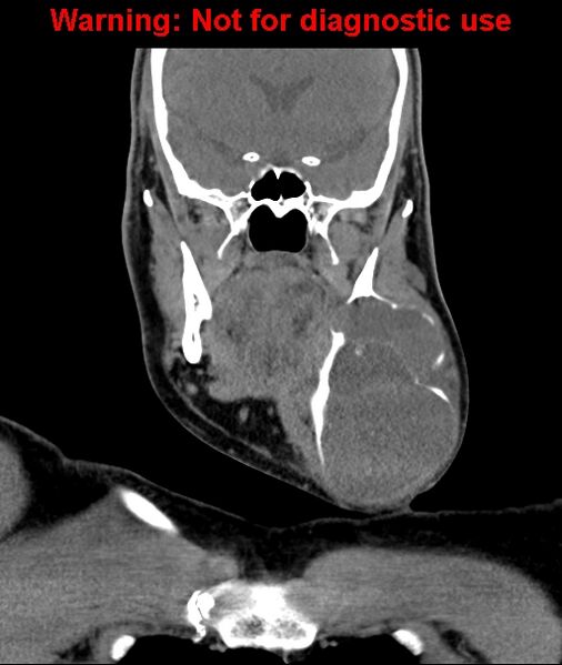 File:Ameloblastoma (Radiopaedia 33126-34164 D 32).jpg