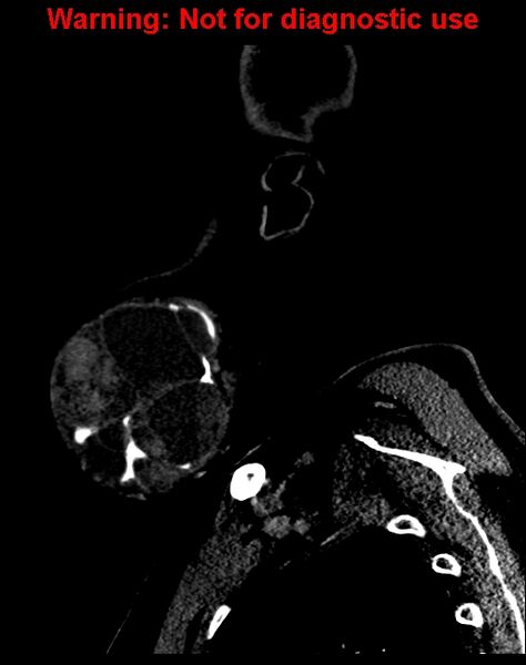 File:Ameloblastoma (Radiopaedia 33126-34164 F 10).jpg