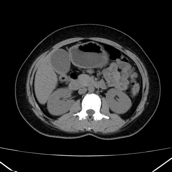 File:Ampullary tumor (Radiopaedia 22787-22816 Axial non-contrast 24).jpg