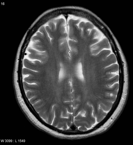 File:Amyotrophic lateral sclerosis (Radiopaedia 5373-7134 Axial T2 16).jpg