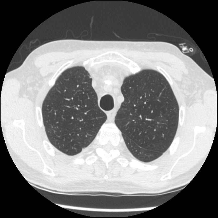 Angioinvasive aspergillosis (Radiopaedia 43957-47466 Axial lung window 16).jpg