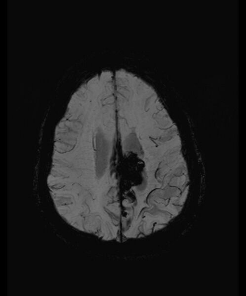 File:Angiomatous meningioma (Radiopaedia 79459-92579 E 48).jpg