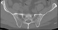 Ankylosing spondylitis (Radiopaedia 11190-11555 Axial bone window 1).jpg