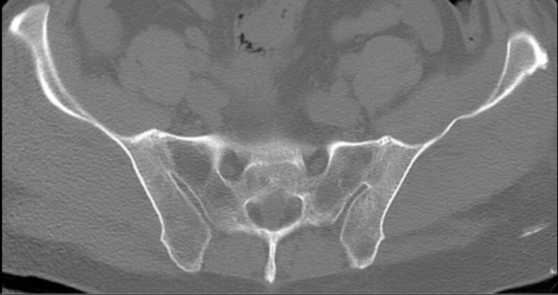 File:Ankylosing spondylitis (Radiopaedia 11190-11555 Axial bone window 1).jpg