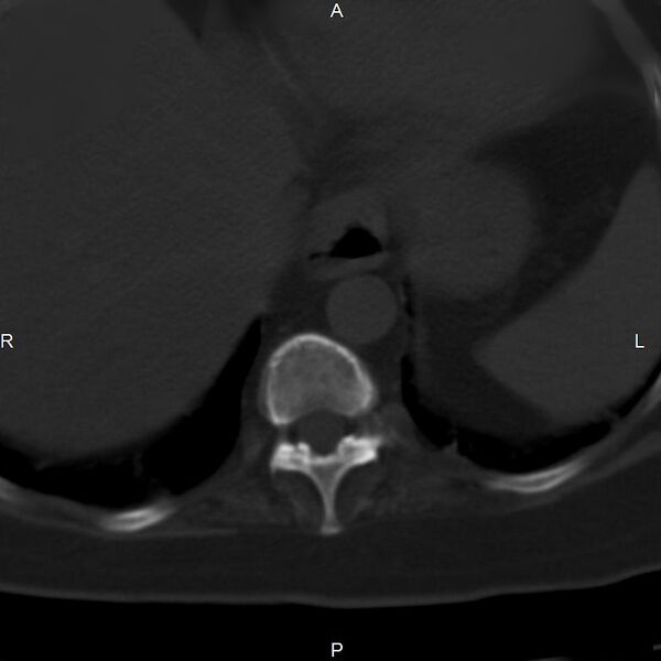 File:Ankylosing spondylitis (Radiopaedia 8748-9556 Axial bone window 8).jpg