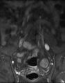 Ankylosing spondylitis - Andersson lesion (Radiopaedia 81878-95838 H 1).jpg