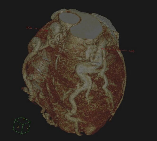File:Anomalous left coronary artery from the pulmonary artery (ALCAPA) (Radiopaedia 40884-43586 3D reconstruction 1).jpg