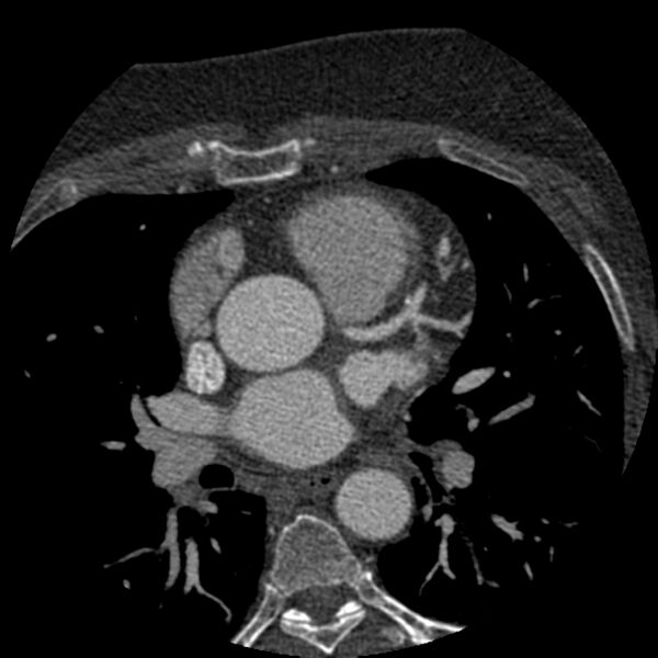 File:Anomalous origin of left circumflex artery from right coronary sinus (Radiopaedia 72563-83117 B 36).jpg