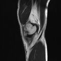Anterior cruciate ligament full thickness tear (Radiopaedia 66268-75467 Sagittal T2 4).jpg