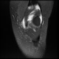 Anterior cruciate ligament tear, Wrisberg rip and bucket-handle tear of medial meniscus (Radiopaedia 75872-87266 Coronal PD fat sat 7).jpg