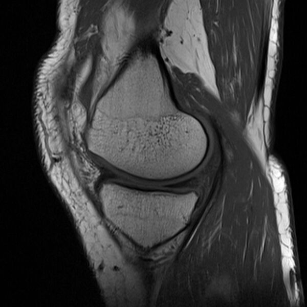 File:Anterior cruciate ligament tear - ramp lesion (Radiopaedia 71883-82322 Sagittal T1 18).jpg