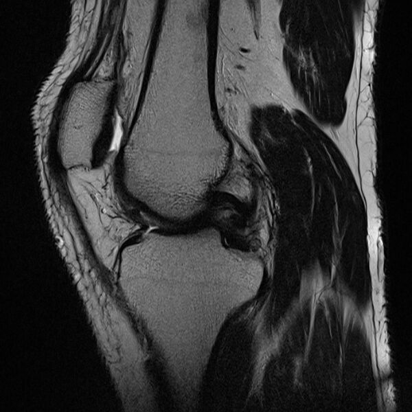 File:Anterior cruciate ligament tear - ramp lesion (Radiopaedia 71883-82322 Sagittal T2 15).jpg