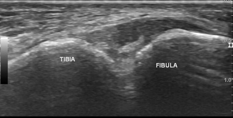 File:Anterior inferior tibiofibular ligament injury (Radiopaedia 65077-74073 Longitudinal 6).jpg