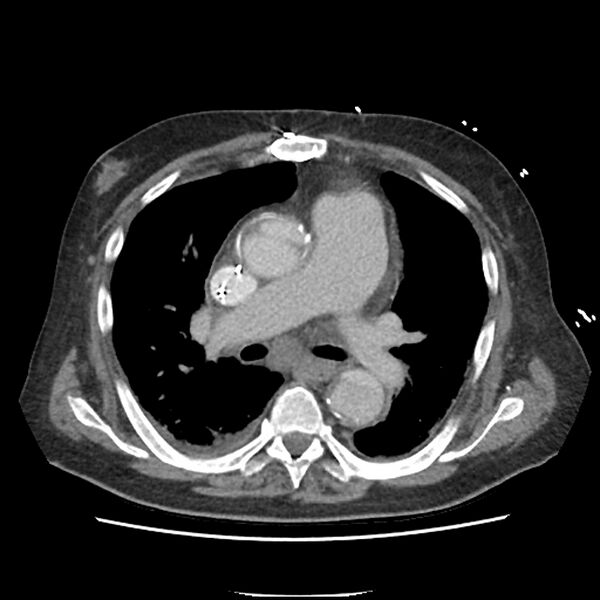 File:Aortic arch graft infection (FDG PET-CT) (Radiopaedia 71975-82437 A 25).jpg