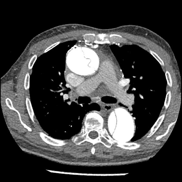 File:Aortic dissection - DeBakey Type I-Stanford A (Radiopaedia 79863-93115 A 15).jpg