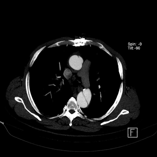 File:Aortic dissection - De Bakey type III - Stanford B (Radiopaedia 21903-21882 B 22).jpg