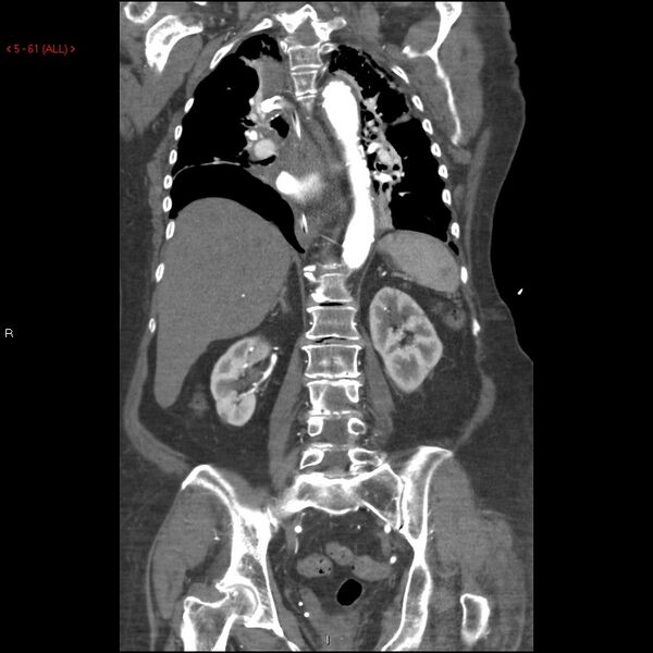 File:Aortic intramural hematoma (Radiopaedia 27746-28001 B 38).jpg