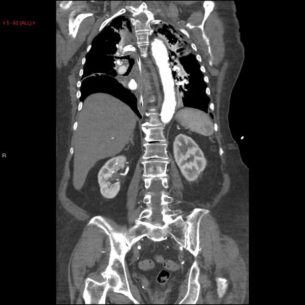 File:Aortic intramural hematoma (Radiopaedia 27746-28001 B 39).jpg