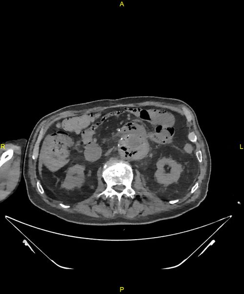 File:Aortoenteric fistula (Radiopaedia 84308-99603 Axial non-contrast 145).jpg