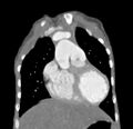 Aortopulmonary window, interrupted aortic arch and large PDA giving the descending aorta (Radiopaedia 35573-37074 D 16).jpg