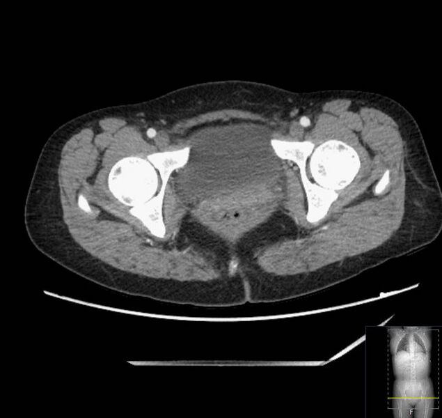 File:Appendicitis (CT angiogram) (Radiopaedia 154713-127660 Axial 74).jpg