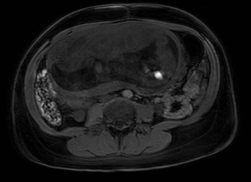 Appendicitis in gravida (MRI) (Radiopaedia 89433-106395 Axial DIXON 76).jpg