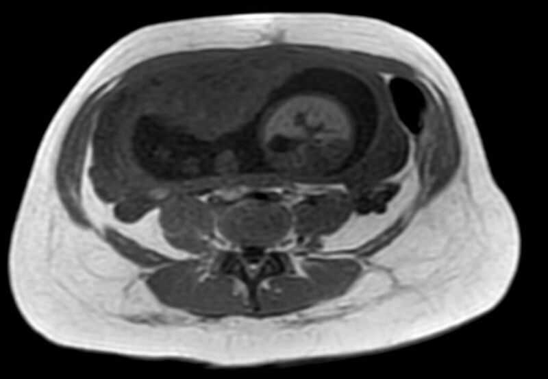 File:Appendicitis in gravida (MRI) (Radiopaedia 89433-106395 Axial T1 in-phase 43).jpg