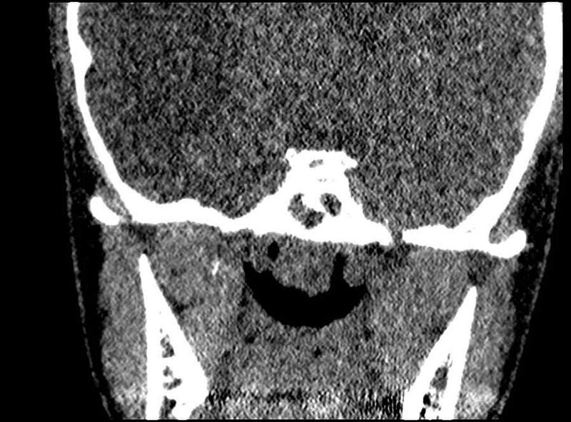 File:Arachnoid cyst- extremely large (Radiopaedia 68741-78450 Coronal bone window 10).jpg
