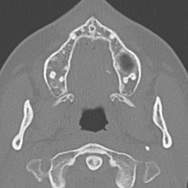 File:Arrested pneumatization of the sphenoid (Radiopaedia 10700-11172 Axial non-contrast 22).jpg