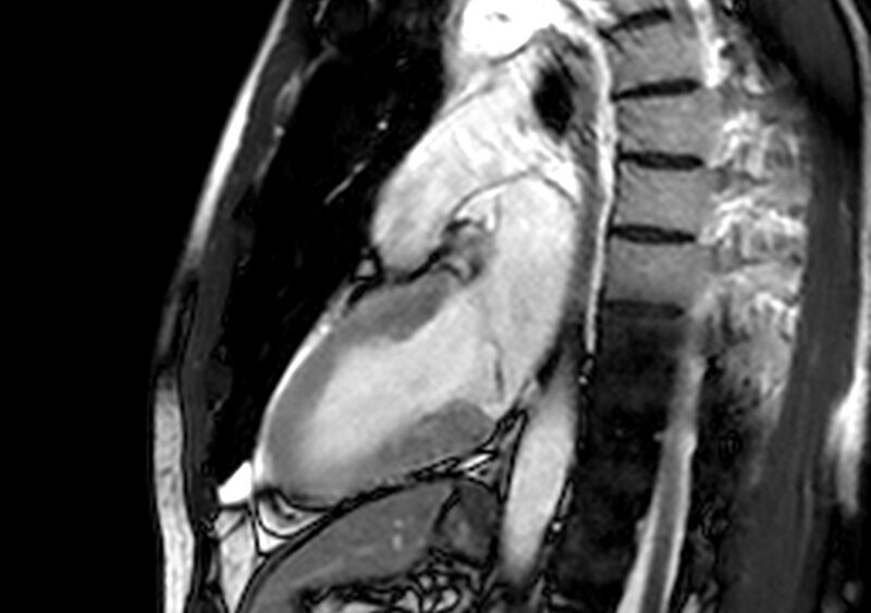 File:Arrhythmogenic right ventricular cardiomyopathy (Radiopaedia 39806-42237 B 9).jpg