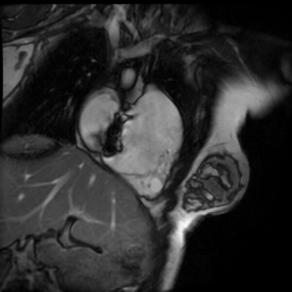 File:Arrhythmogenic right ventricular cardiomyopathy (Radiopaedia 87505-103850 2ch (RV) Cine SSFP 85).jpg