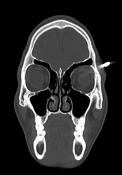 File:Arrow injury to the head (Radiopaedia 75266-86388 Coronal bone window 28).jpg