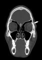 Arrow injury to the head (Radiopaedia 75266-86388 Coronal bone window 28).jpg