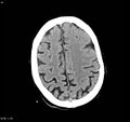 Arteriovenous malformation - cerebral (Radiopaedia 8172-9020 Axial non-contrast 18).jpg